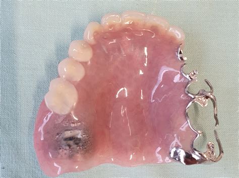 Partial Dentures (plates) - Northland Prosthodontics - Northland Denture Specialist - Whangarei