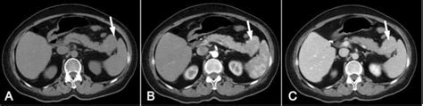 Intrapancreatic accessory spleen: Evaluation with CT and MRI