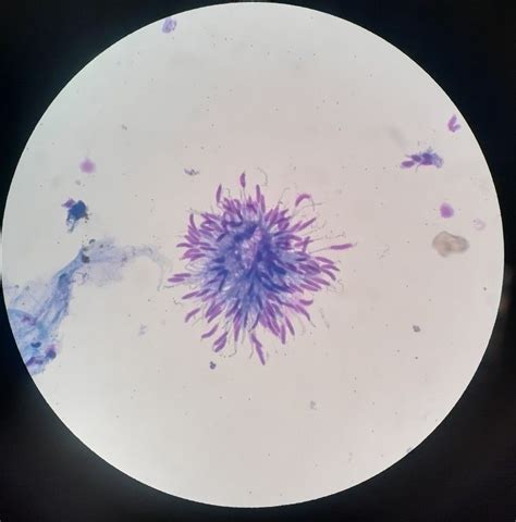 Stromal cells in cytology specimen | Microscopio