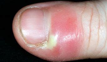 Nail abnormalities - NHS Choices | Nail problems, Nails, Nail disorders