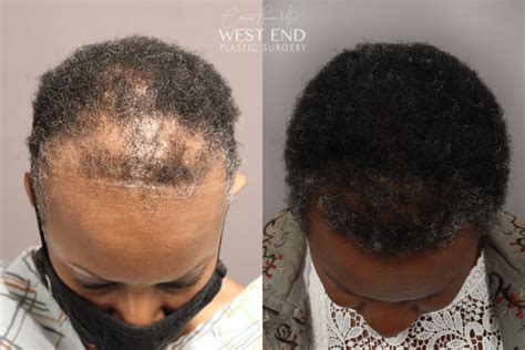 Female Hair Loss Washington, DC - Female Hair Loss Treatment