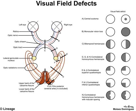 Visual Field Defects - Ophthalmology | Medical school inspiration, Medical knowledge, Eye anatomy