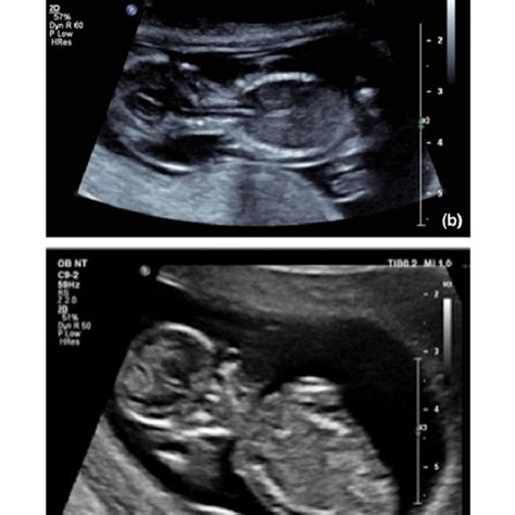 (a) US Image Showing an Increased Nuchal Thickness of 8.93 mm at 13... | Download Scientific Diagram