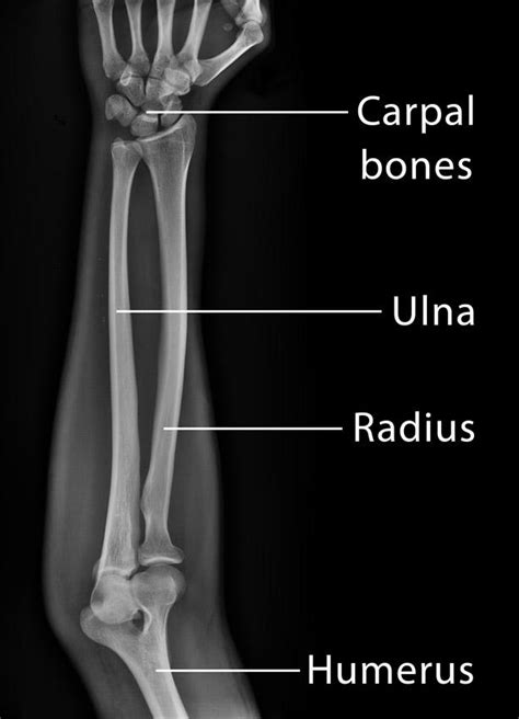 Radius And Ulna X Ray