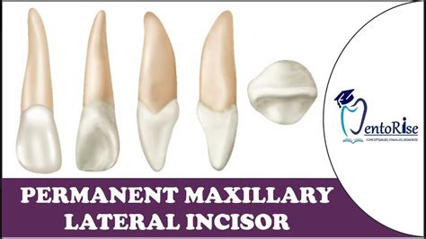 Permanent Maxillary Lateral Incisor | Tooth Morphology | Dental Anatomy - YouTube