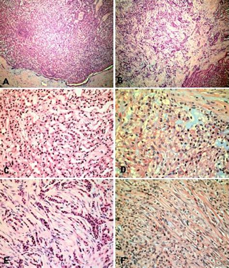 Kidney: Mucinous tubular and spindle cell carcinoma