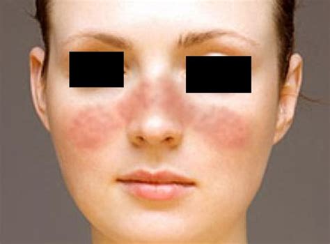 Butterfly Rash (Malar Rash) - Pictures, Treatment, Symptoms, Causes | hubpages