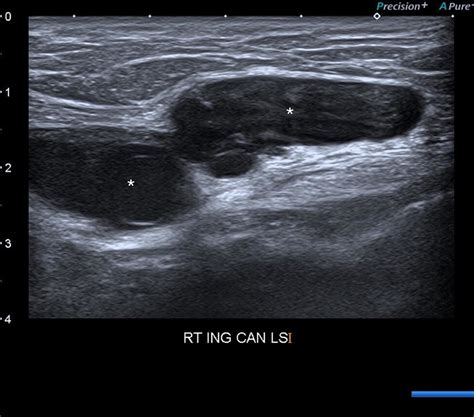 Hydrocele of the Canal of Nuck. Longitudinal ultrasound image of the... | Download Scientific ...