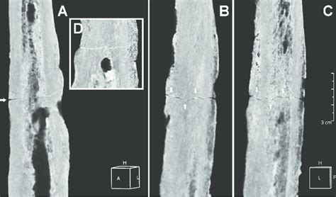 Three-dimensional (3D) computed tomography (CT) scan of the femoral... | Download Scientific Diagram