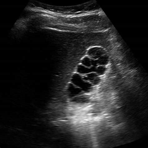 Gallbladder Fold Ultrasound