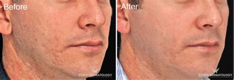 Fillers for Acne Scars: Efficacy, Before and Afters, Cost and More