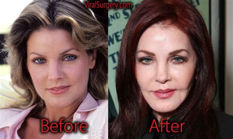 Priscilla Presley Plastic Surgery, Before and After Facelift Pictures