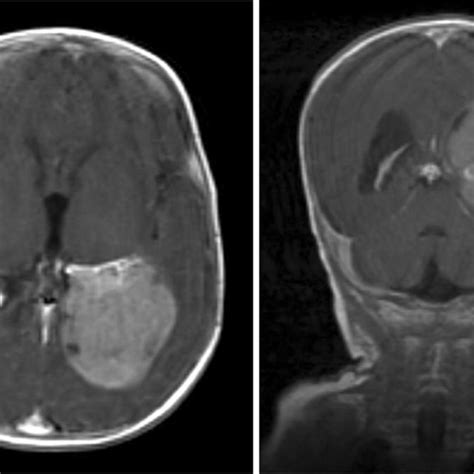 Preoperative MRI, post insertion of VP shunt. An avidly enhancing... | Download Scientific Diagram