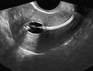 Abnormal Uterine Bleeding: The Role of Ultrasound | Radiology Key