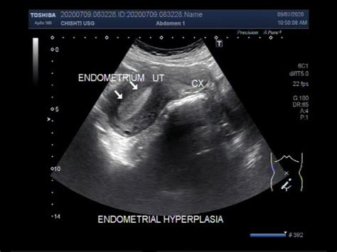 Adolescent Technology: [Get 29+] Uterine Cancer Ultrasound Endometrial Hyperplasia