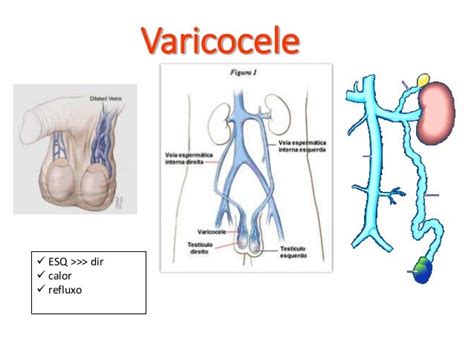 Varicocele Repair - Principals and Microsurgical Technique