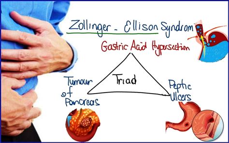 Zollinger Ellison Syndrome Homopathic treatment India Punjab