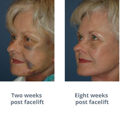 Skin Discoloration After a Facelift | Facial Surgery & Aesthetics Center