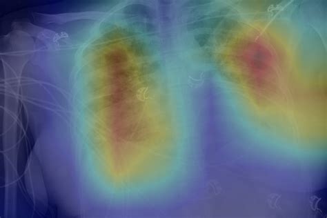 Radiologists use deep learning to find signs of COVID-19 in chest X ...