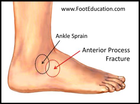 Anterior Process Fracture of the Calcaneus - FootEducation