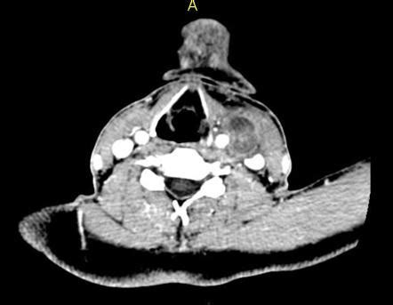 Carotid artery pseudoaneurysm | Radiology Reference Article | Radiopaedia.org