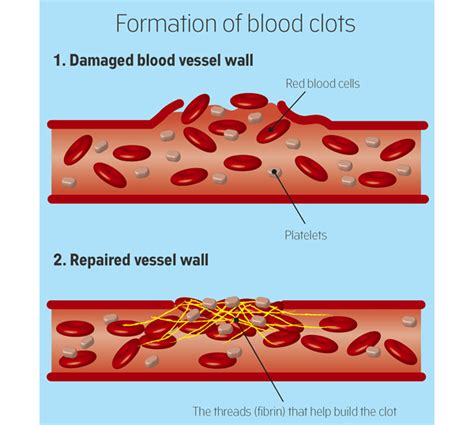 How blood clots go from good to bad | CancerClot™