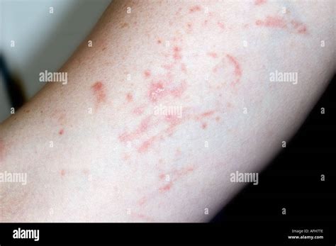 Eczema showing the Koebner Phenomenon Stock Photo - Alamy