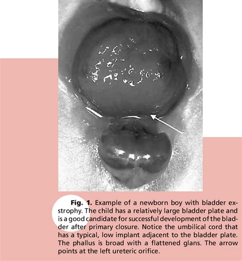 Bladder Exstrophy Embryology