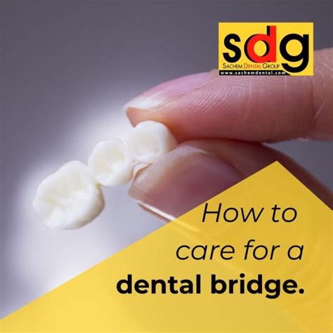 How To Care For My Dental Bridge - Sachem Dental Group