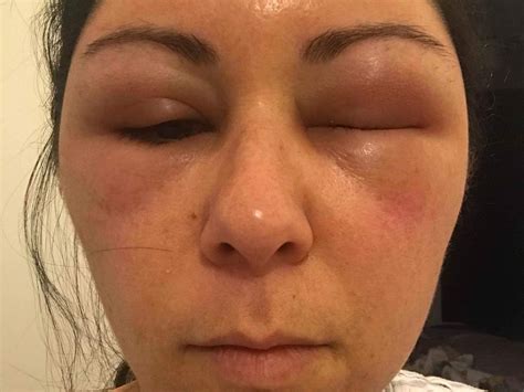 Woman’s head swells like a balloon after shocking allergic reaction to ...