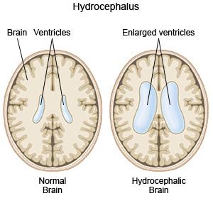 Hydrocephalus | Wonder