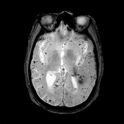 Brain microbleeds | Practical Neurology