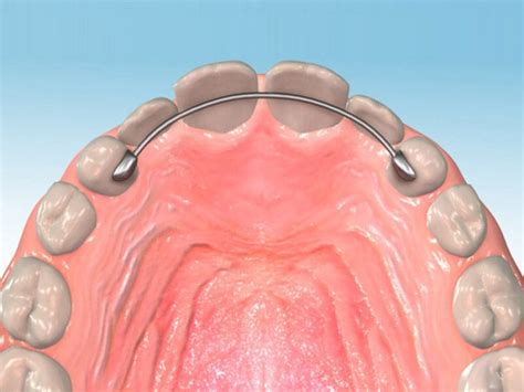 What is a Permanent Retainer? - Health Row