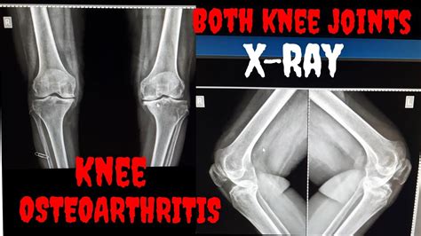 Both Knee Joint Osteoarthritis || Knee Joints AP & Lat|| X-ray positioning|| Radiography with ...