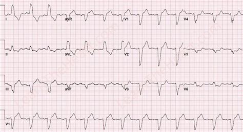 Dr. Wassim Shaheen--New LBBB on EKG; What should we do? | Heartland ...