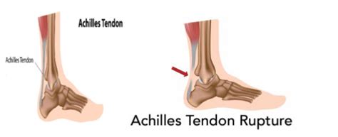 Achilles tendon rupture: management and rehabilitation | CUH