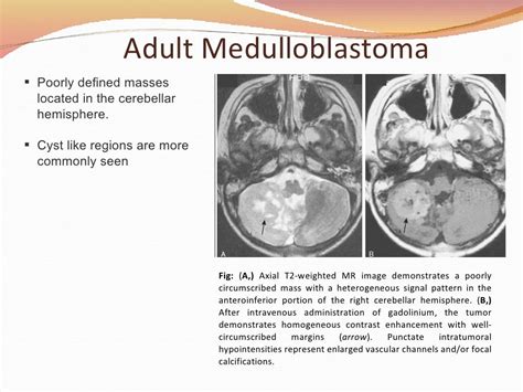 Diagnosis, Treatment & Management of Medulloblastoma