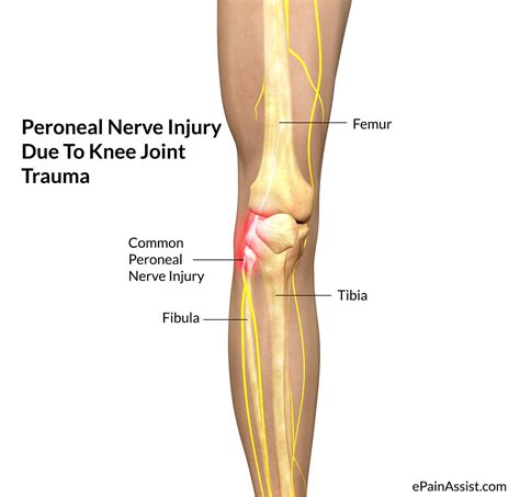 Peroneal Nerve Injury - Treatment, Causes, Symptoms