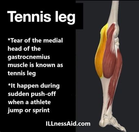 TENNIS LEG: CAUSES, SYMPTOMS, EXERCISES - ILLnessAid