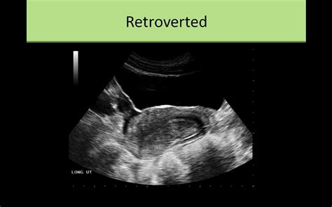 Pelvic Sonography | Sonography, Medical ultrasound, Ultrasound