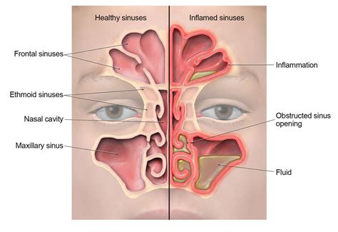 Sinus Infection (Sinusitis) | Community | Antibiotic Use | CDC