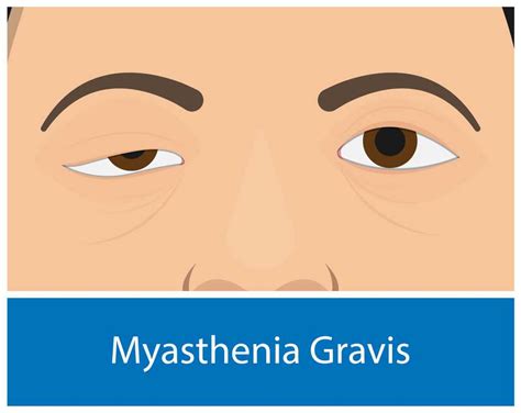 Myasthenia Gravis; Symptoms, Causes & Treatment - Page 2 of 10 - A2Z Healthy