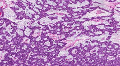 Invasive mucinous carcinoma of the breast | MyPathologyReport.ca