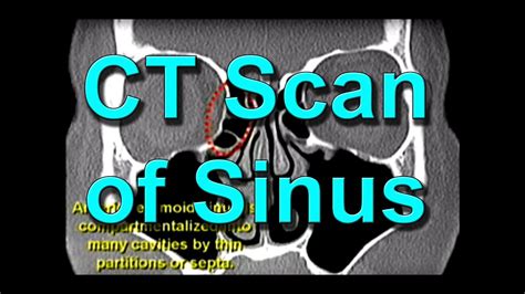 How To Read CT Sinus Scans Like An Expert - YouTube