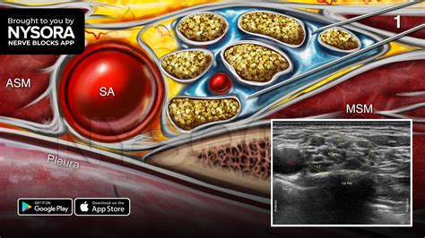 Supraclavicular Nerve Block