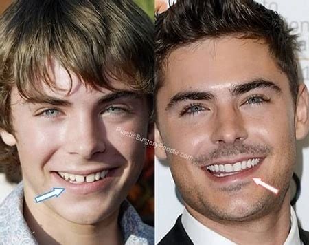 Zac Efron’s Plastic Surgeries and Teeth Modification – Before and After Pictures | Glamour Path