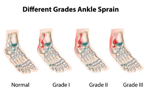 Ankle Sprain Treatment | OrthofootMD