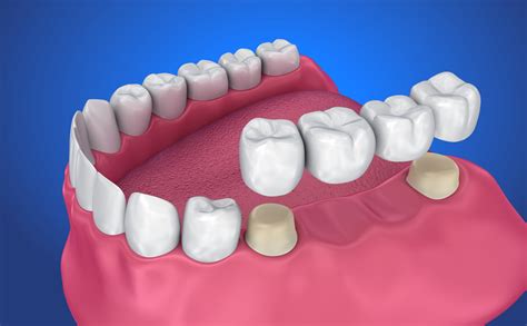 What Is A Tooth Supported Bridge at ronaldjwinston blog