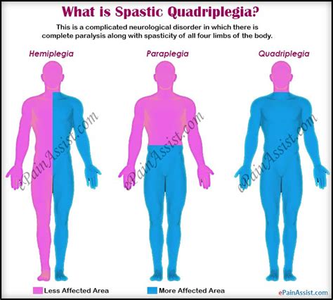 Spastic Quadriplegia: Treatment, Complications, Symptoms, Causes