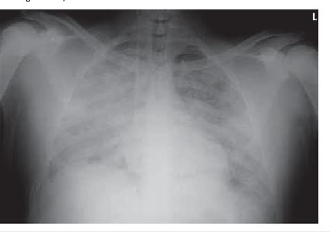 Figure 1 from Negative Pressure Pulmonary Edema in a Child Following ...